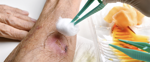 Complex Wound Care (NDIS) 